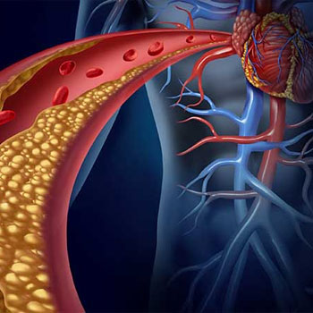 Hoogcholesterol https://www.sportsereen.nl/wp-content/uploads/2023/08/Hoogcholesterol.jpg